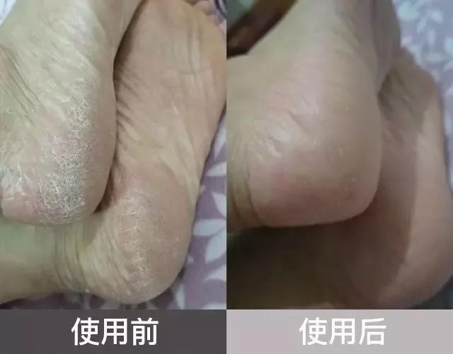 澳洲顶级护脚膏,凡士林手足防裂膏妈妈用