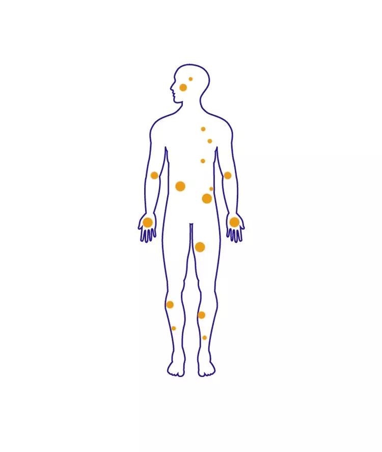 湿疹，当代老中青三代不治之症