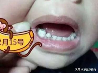 小孩蛀牙疼痛可以补牙吗,小孩蛀牙痛怎么缓解最有效