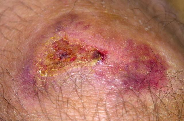 伤疤结痂怎么老不掉啊,伤疤结痂后为啥很长时间不愈合