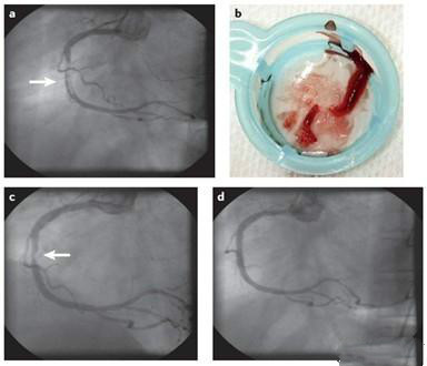 抗血栓药，有哪些？它们之间有哪些不一样？听听医生怎么说