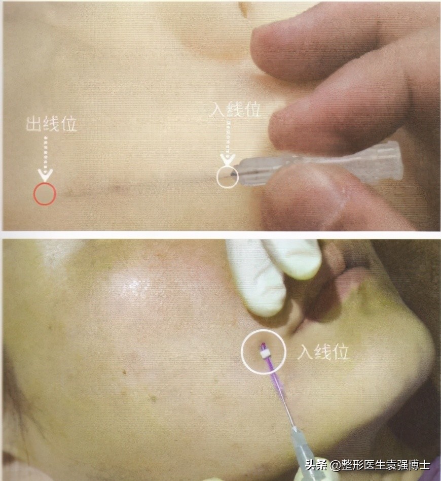 线雕“过时”了？医生说出实情