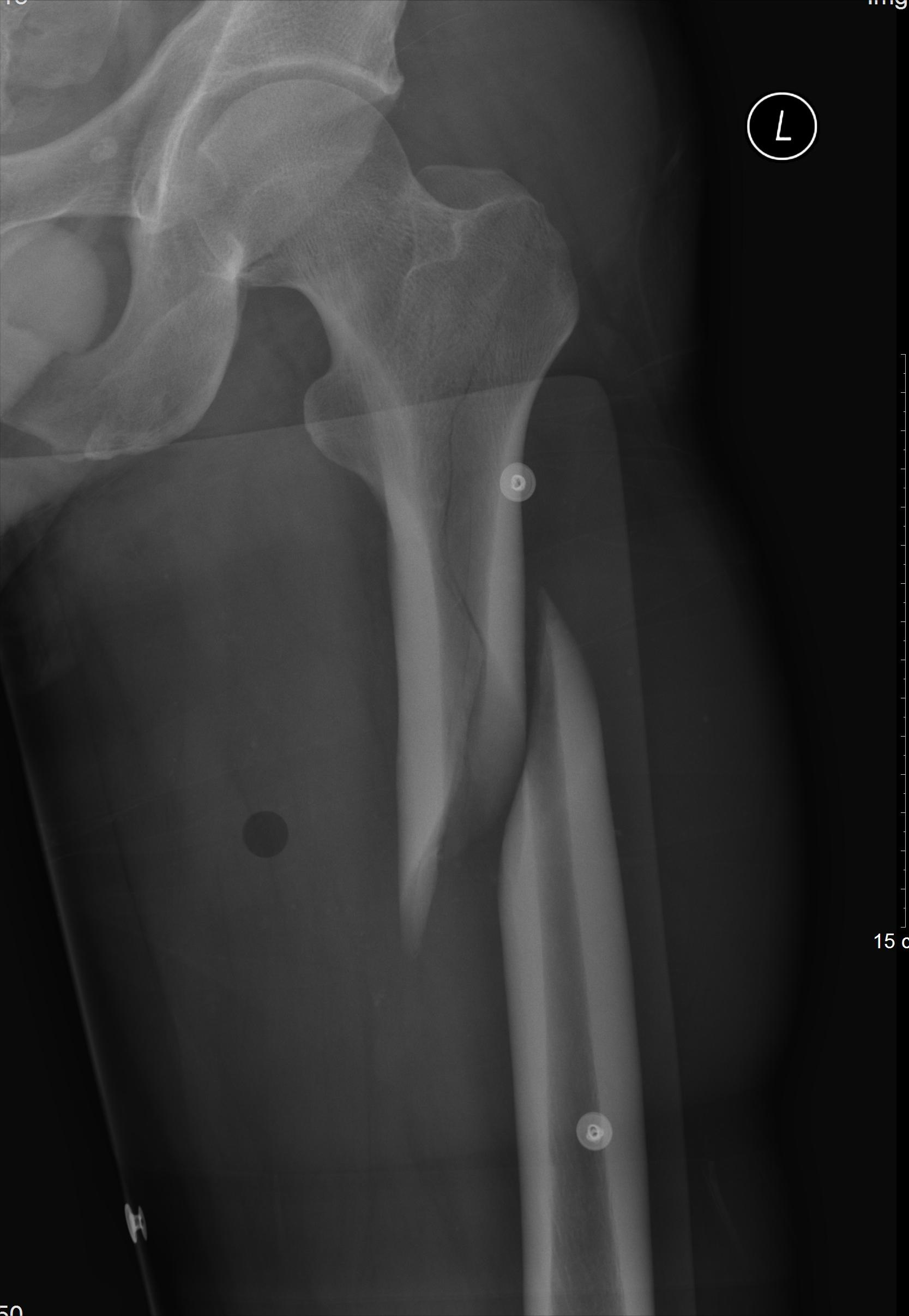 从瘫痪到重头站起来,瘫痪后重头站起来的有吗