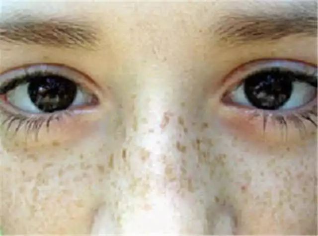 儿童面部不由自主抽动是什么原因,面部两眉之间皮肤抽搐是什么原因