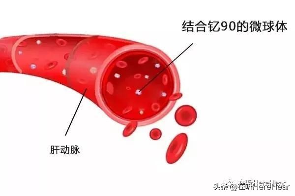 香港癌症治疗最新突破,香港有没有治疗肝癌晚期的药