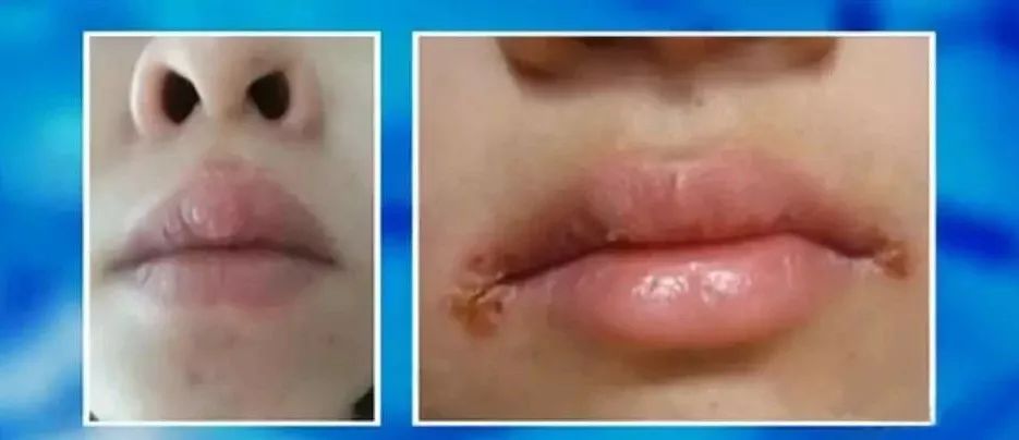 人体危险三角区的危害,身体三角区有哪些危险