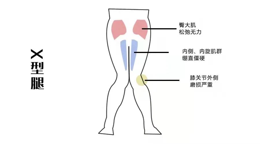 x型腿真的是骨头弯了吗,x型腿是怎么养成的