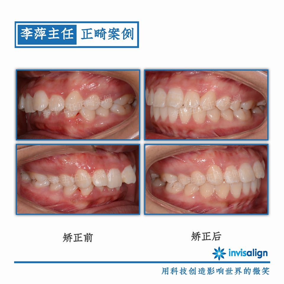 太原隐形牙齿矫正哪家靠谱,太原李萍正畸怎么样