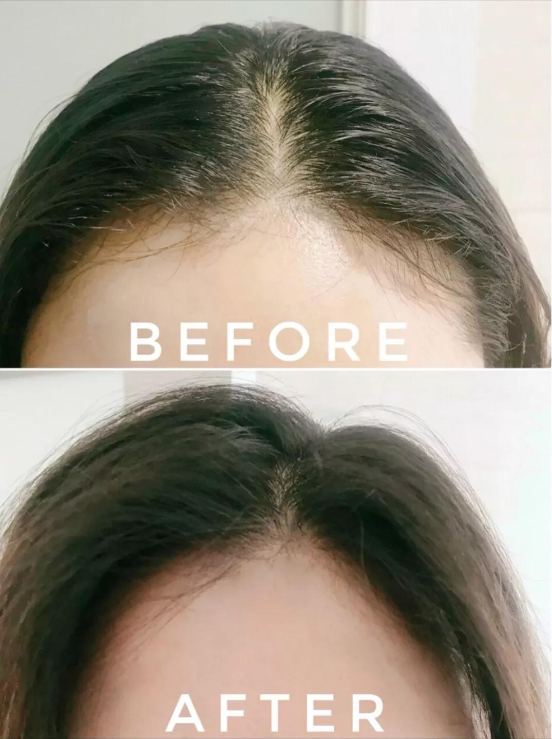 头皮一直出汗痒,头皮多痒出油掉发严重怎么办