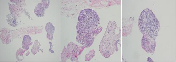 肺部陈旧病灶会变大么,肺部病灶1.2厘米严重吗