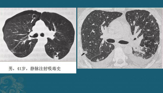 化脓性肺炎，硬扛3天不吃抗生素必后悔，这个细菌专治各种不服