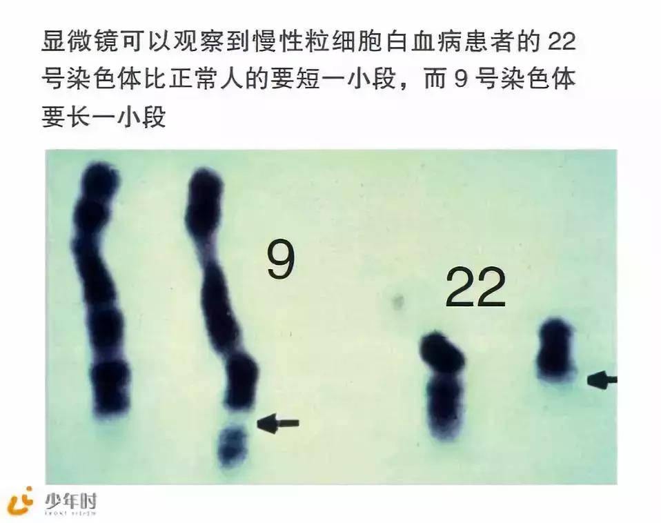 费城染色体形成原因,费城染色体会有什么影响