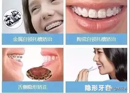 2020牙齿矫正攻略请查收,今日头条修复牙齿