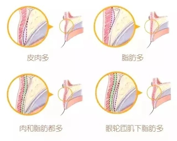 天生肿眼泡脂肪怎么消除,肿眼泡怎么分清皮肤厚和脂肪多