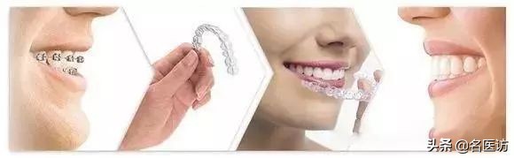 2020牙齿矫正攻略请查收,今日头条修复牙齿