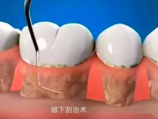消失的牙周炎,消失的中国牙周炎患者