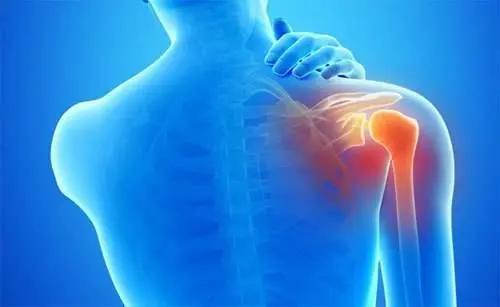 让你不再“肩”熬——肩峰下撞击综合征全攻略