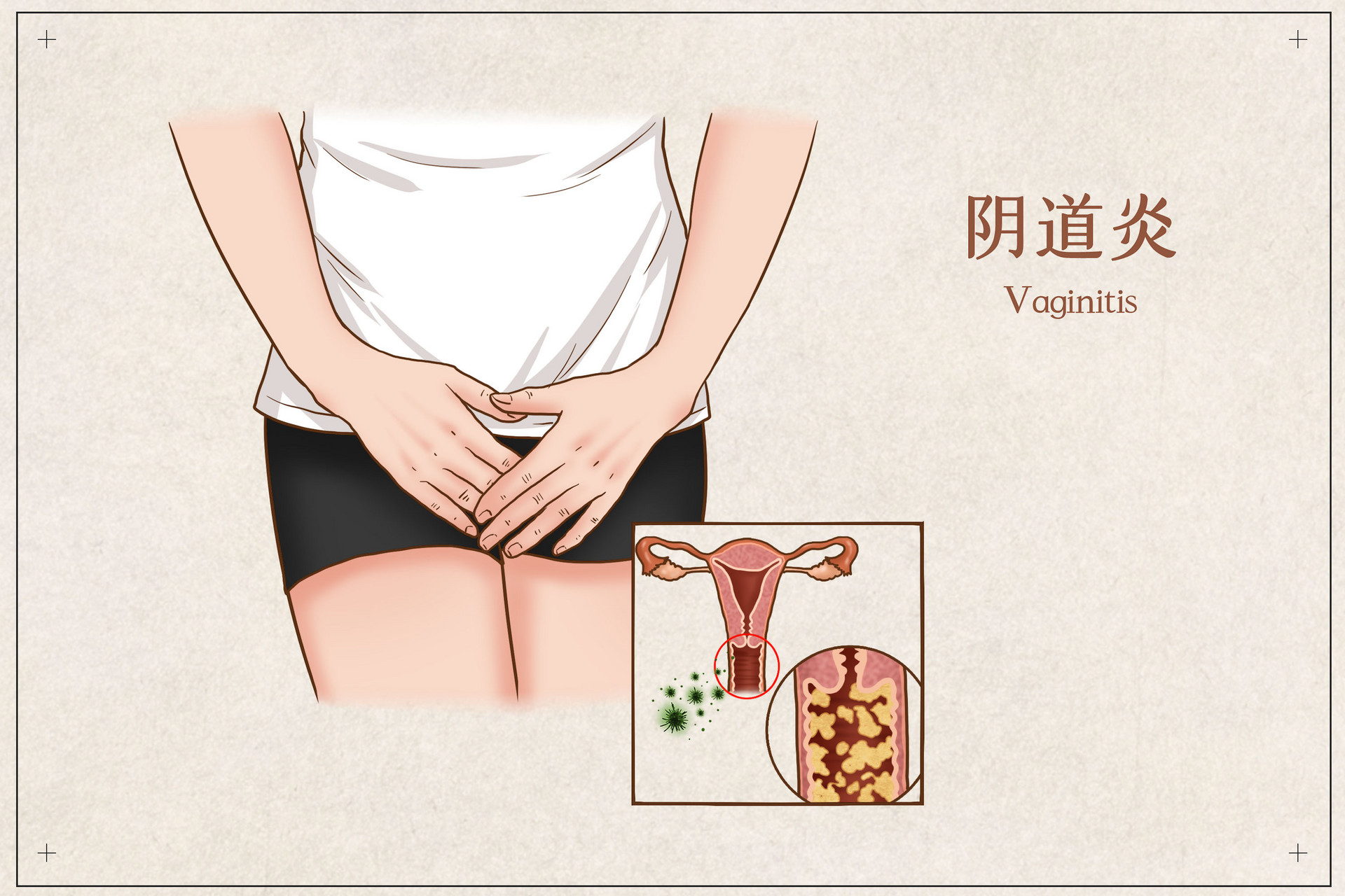 生活中作出来的阴道炎？女人要关注避开，都藏在这4个方面