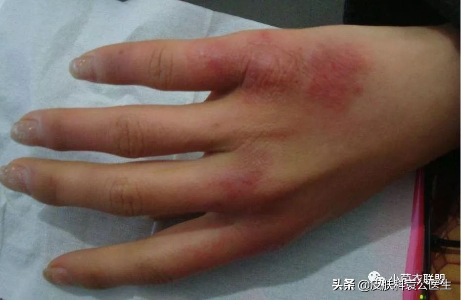 冻疮后期接触水干燥发痒怎么治,冻伤痒痛