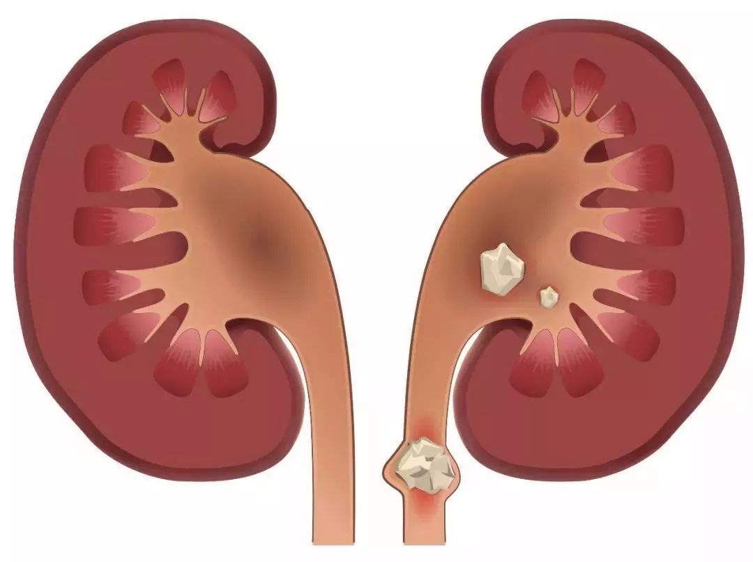 双肾结石手术后五月后又有新结石,女子右肾取出一盘结石
