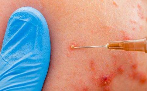 脸上总挤出白色分泌物还很臭,脸上挤出白色分泌物而且还有血