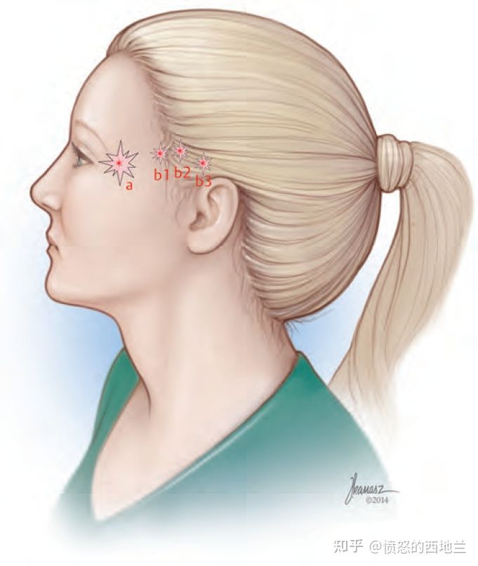 微创手术对偏头痛的治疗