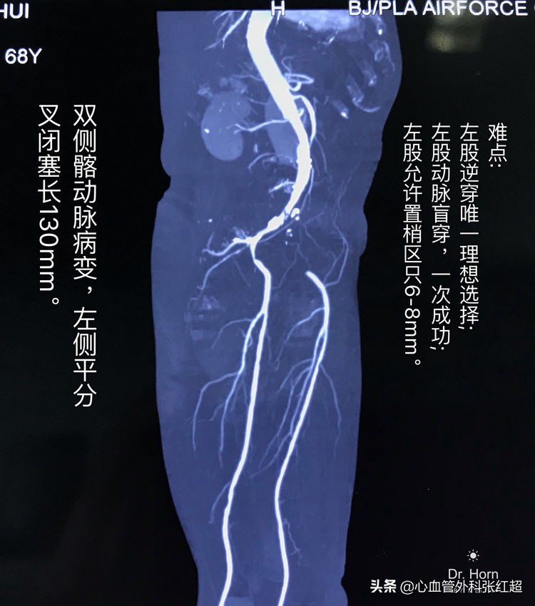 外周血管外科治疗范围,外周血管介入治疗疗程