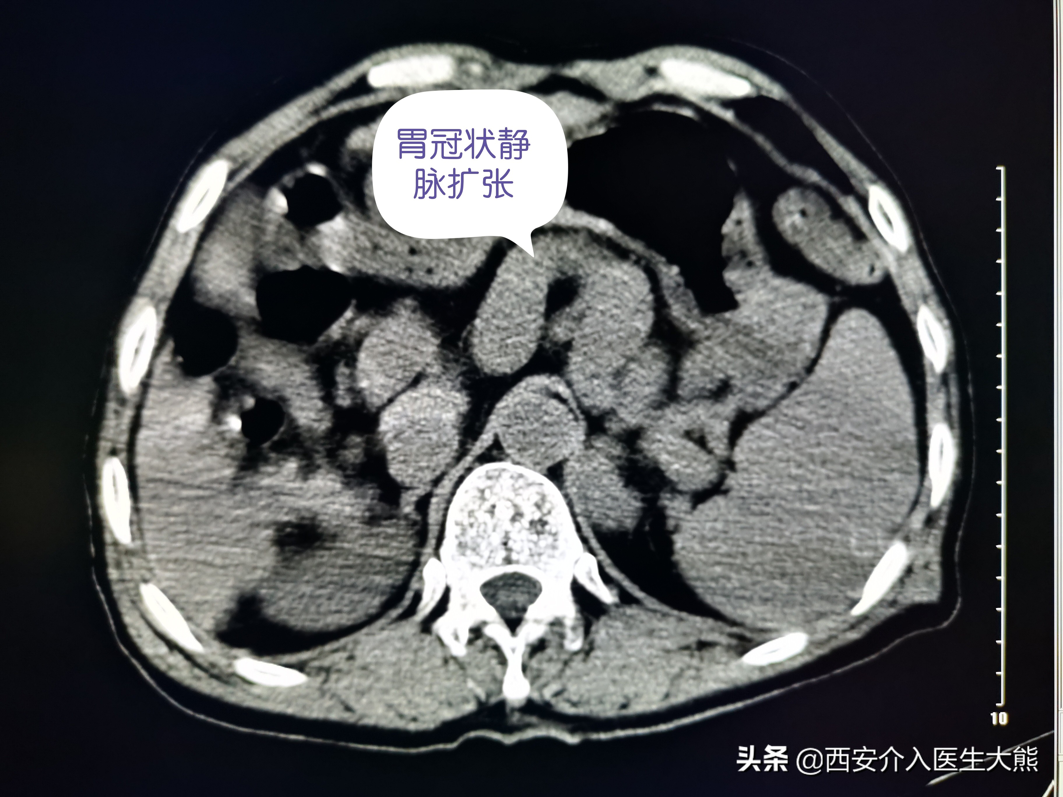 肝硬化消化道出血的病例护理讨论,肝硬化引起的消化道出血如何治疗