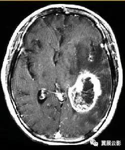 脑脓肿增强扫描是环形强化吗,脑部脓肿