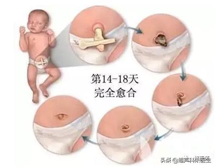 脐带脱落前有黄色分泌物正常吗,脐带脱落后出血新生儿脐带护理