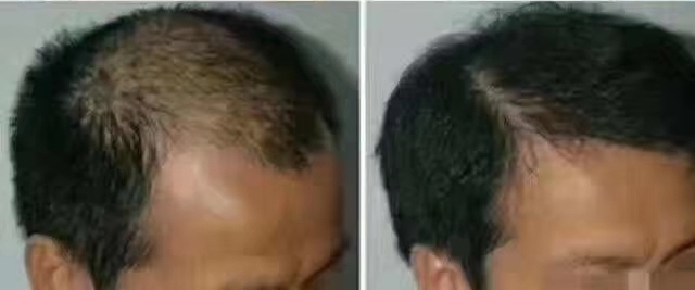 生发止脱发真实案例,脱发患者重头生发案例