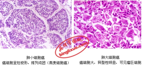 肺癌早晚期怎么分辨,肺癌如何判定早期晚期