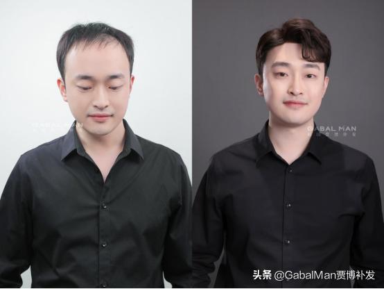 怎样选择一款适合自己的假发,怎样选假发和佩戴假发最自然