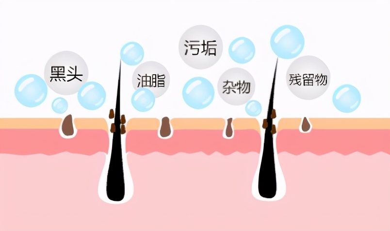 脸上的黑头粉刺该不该挤出来,青少年脸上黑头粉刺如何去除