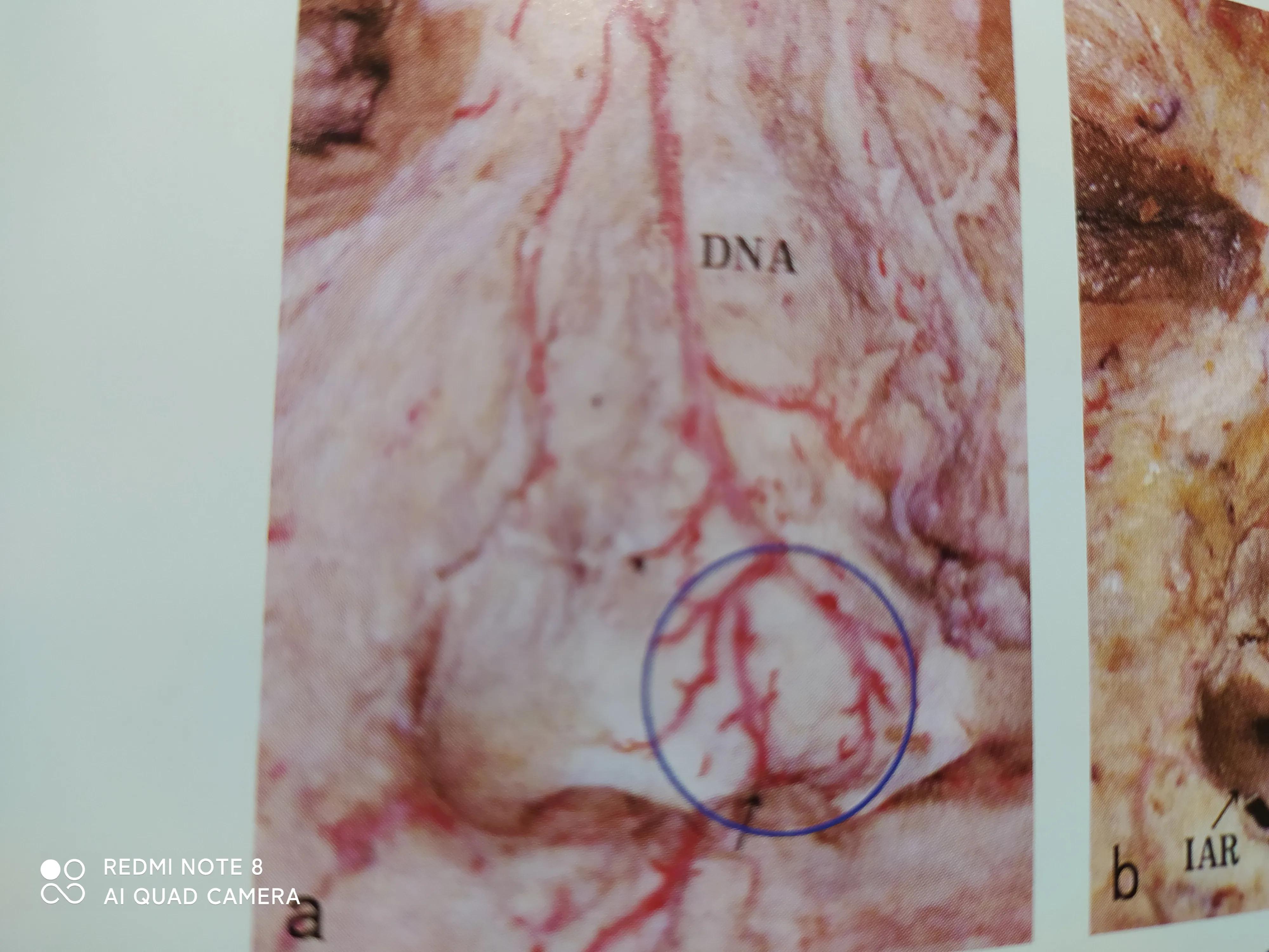 玻尿酸栓塞是打玻尿酸的位置吗,玻尿酸打鼻子栓塞好的过程