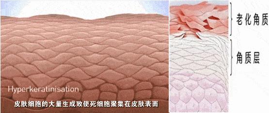泰国发明的去角质慕斯火了！搓一搓脏东西就出来，脸上干净又白嫩