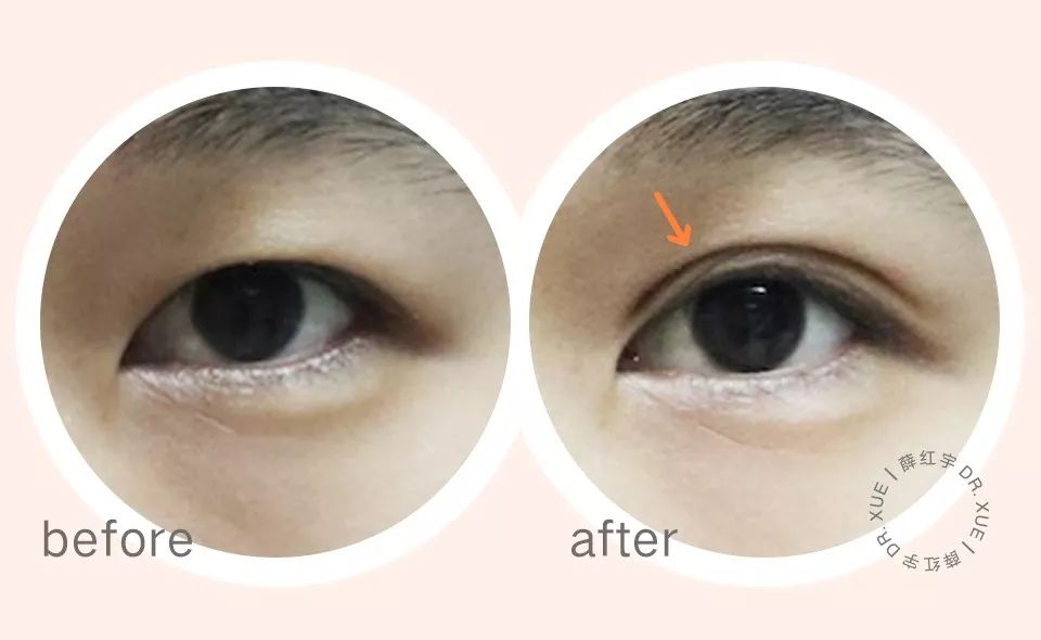 从美术角度谈眯眯眼,开内眼角传统术式