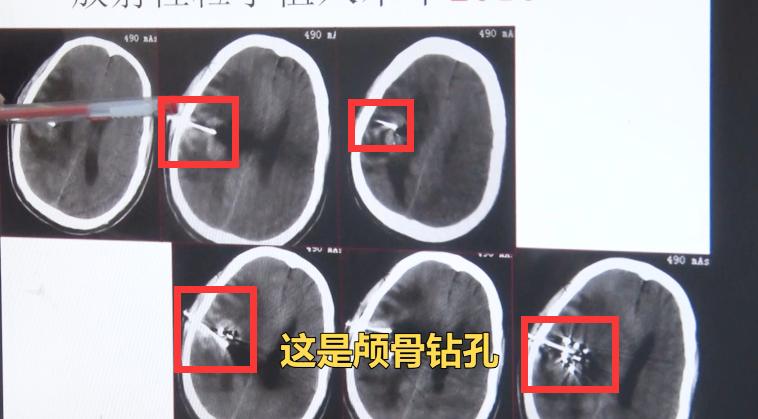 肺癌转移到脑癌死前3个月症状,48岁女子肺癌晚期死亡