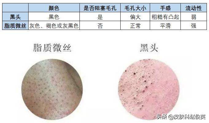 鼻子上没有黑头但是很多色素,中性皮但是鼻子好多黑头