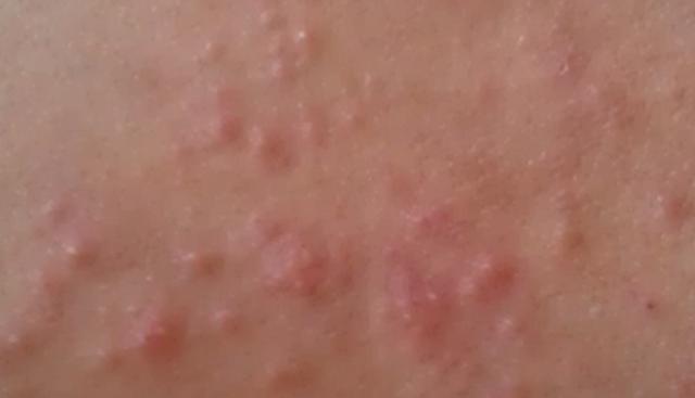 湿疹最怕这四样,湿疹最怕的五种行为千万别做