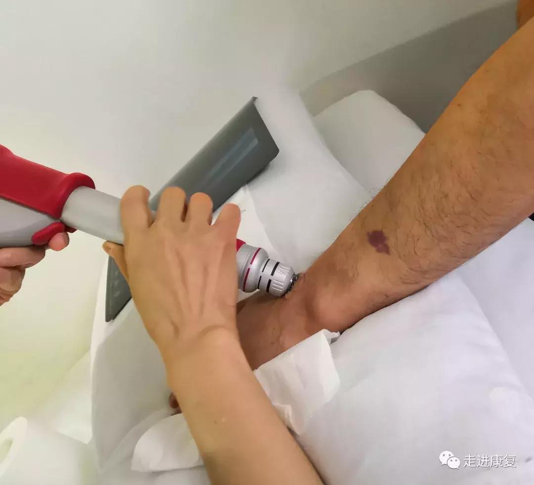 康复科的冲击波能频繁打吗,康复科体外冲击波