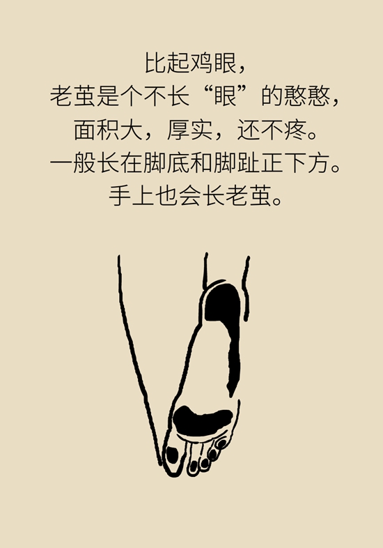 长了鸡眼该怎么办四大妙招教给你,长了鸡眼怎么治疗好得快