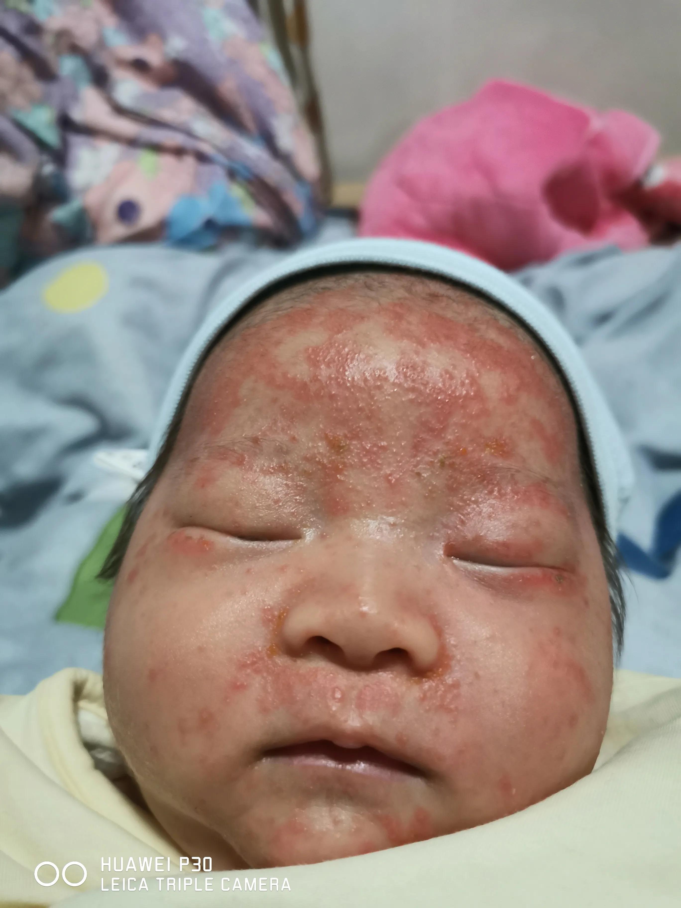 你还在为湿疹烦恼吗,湿疹真的那么恼人吗