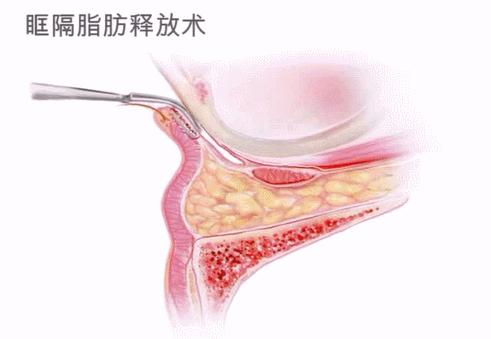 去眼袋一问一答,祛眼袋要咨询什么问题