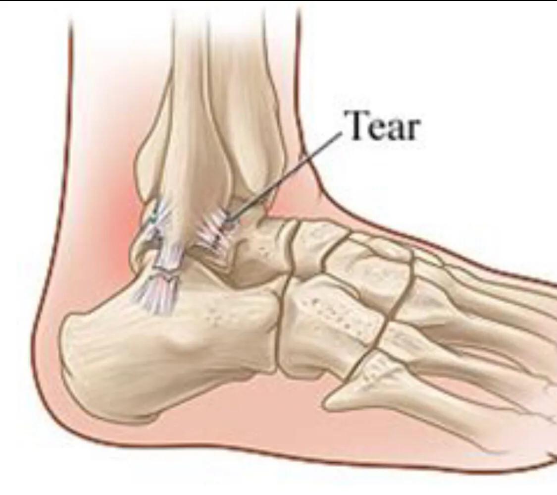 崴脚了要怎么自救,脚崴了一个月了该怎么办