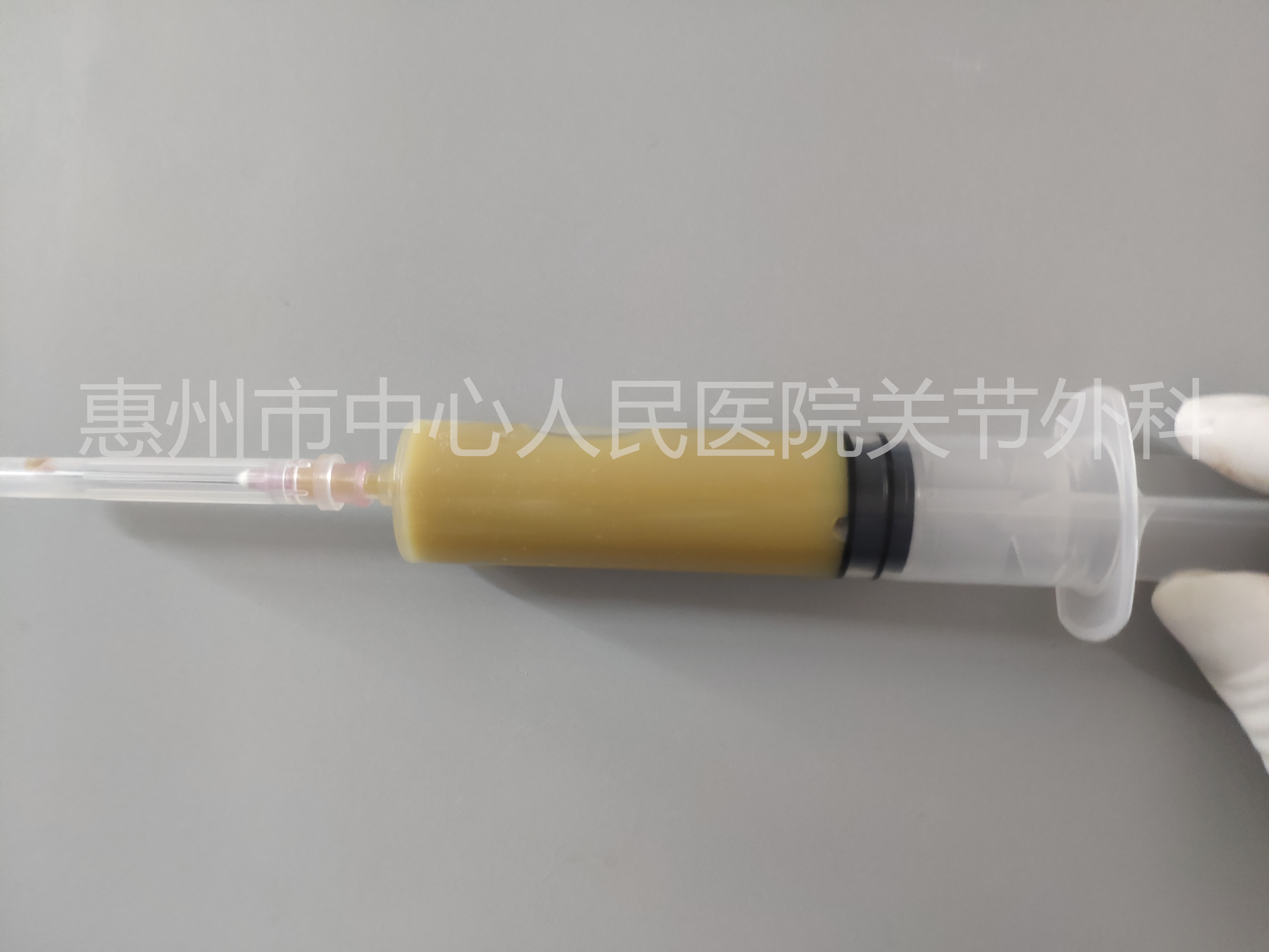 关节炎的病理知识,关节炎科普视频