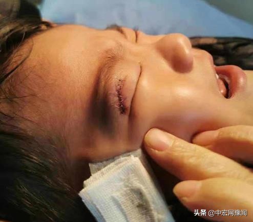 洛阳4岁娃游乐场摔破眼皮缝14针游乐场：监护人有责任