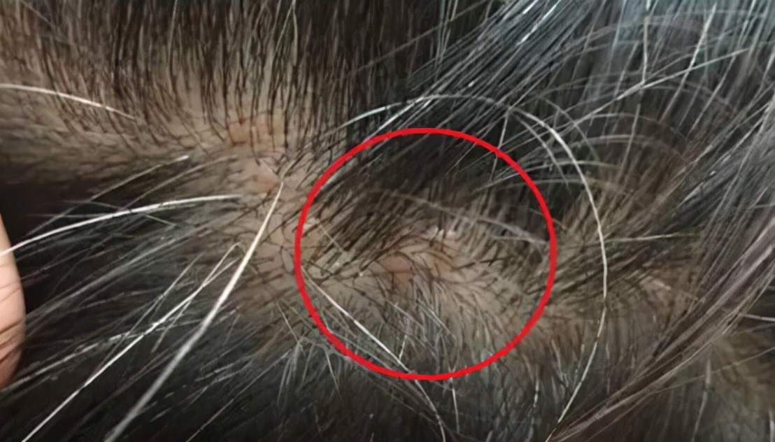 头发出现疙瘩,头发长出红疙瘩怎么回事
