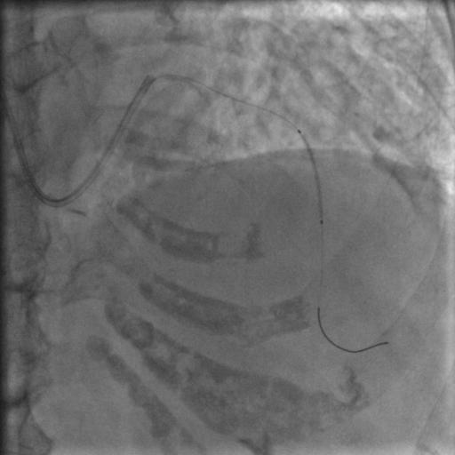 85岁老人心脏堵塞,77岁老人冠脉狭窄放支架还是搭桥
