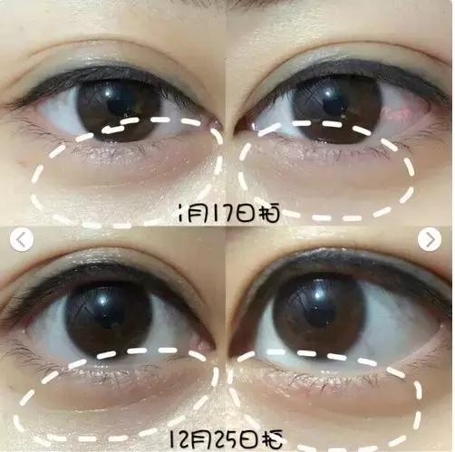 改善眼袋仅980元不开刀让你更出众,消除眼袋细纹大概多少钱